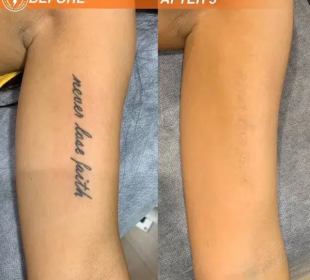 tattoo removal laser