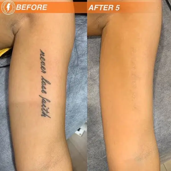 tattoo removal laser